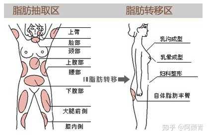 自体抽脂隆胸安不安全? !