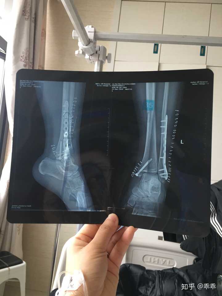 右内踝骨折手术后是一种怎样的体验?
