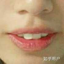 11:11】 正畸前 尖嘴角 正畸中 收缝一个月 嘴外翻 肿胀 圆嘴角, 侧面