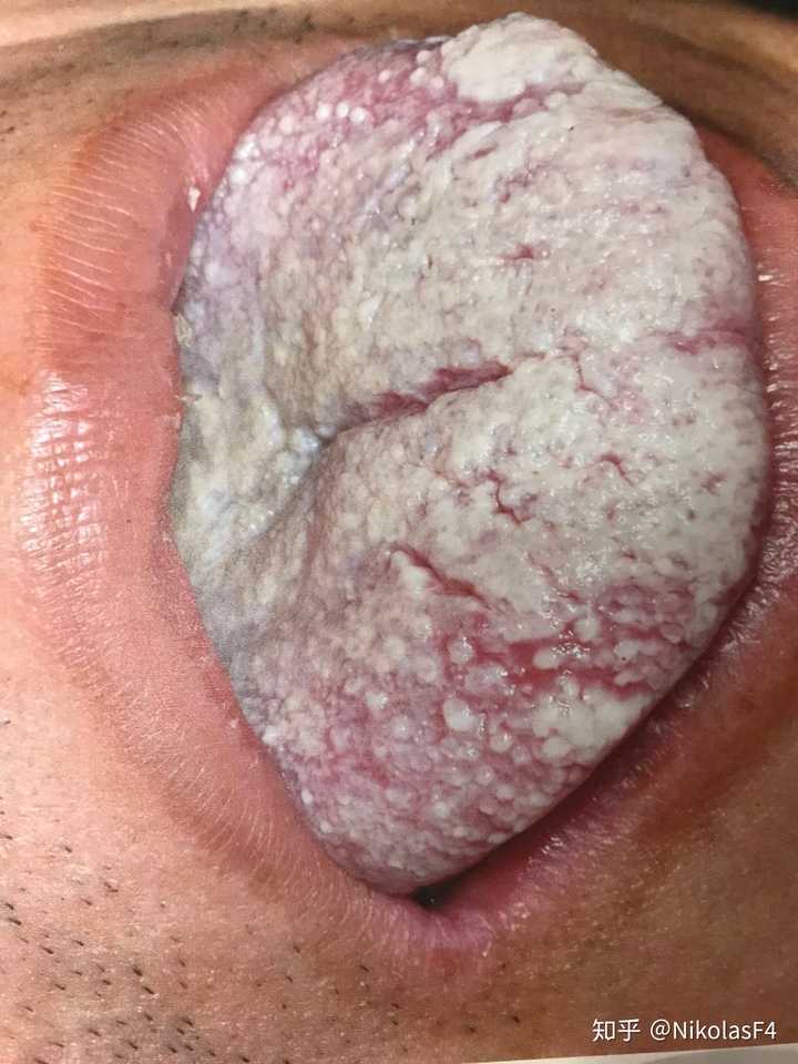 艾滋病(舌背白色假膜)