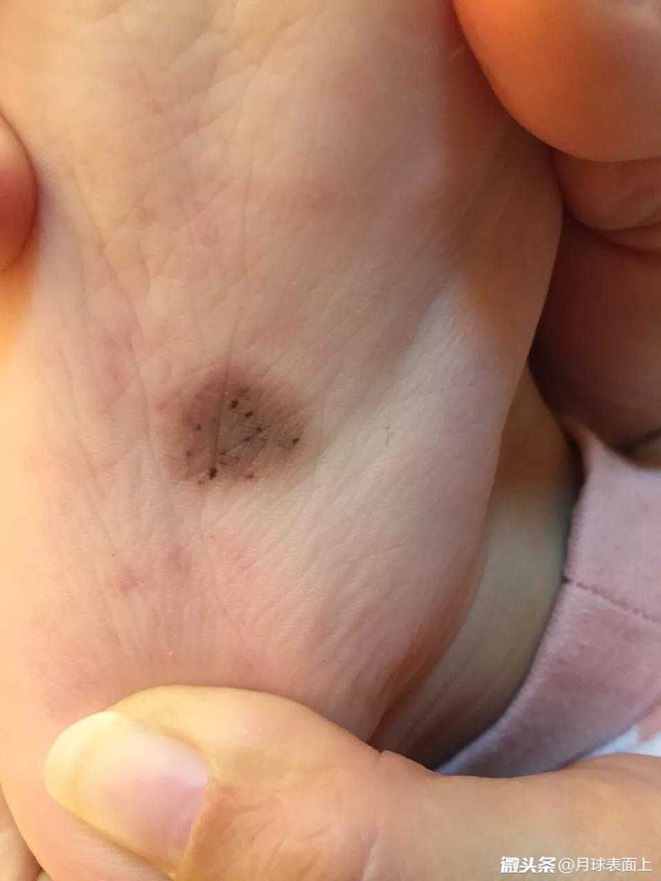 像这个宝宝脚底板的这个色素痣还是建议在孩子可以配合医生治疗的情况