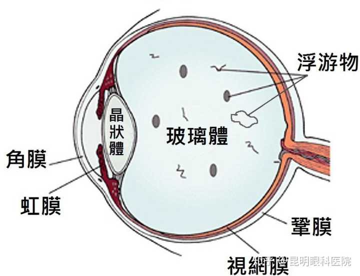 飞蚊症严重吗?