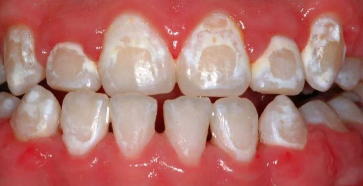 牙齿脱矿是指人的牙齿牙釉质表面的钙磷脱落,因而使牙齿色泽改变,呈