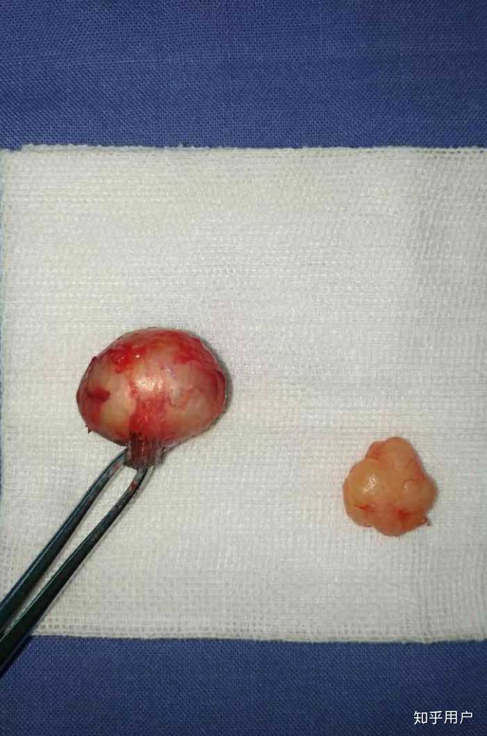 完整切除的皮脂腺囊肿(左,和脂肪瘤(右)