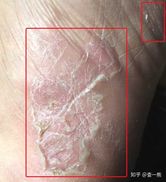 我的脚上皮肤怎么了?