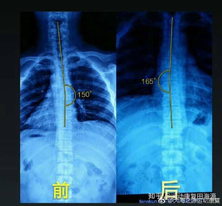 肩胛骨缝粘连是怎么形成的?