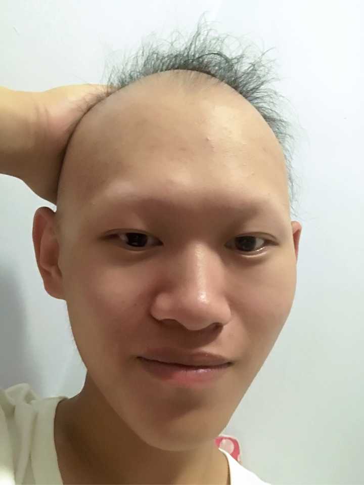 斑秃是一种什么样的体验?求解?