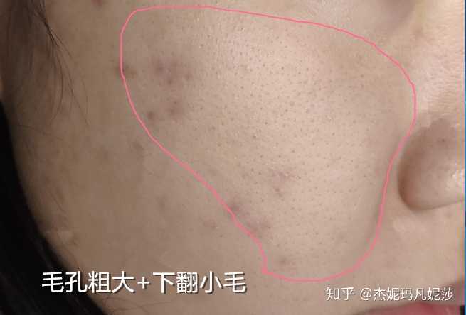 虽然面部其他位置也经常一大片黑点, 比如下面这个脸颊部位