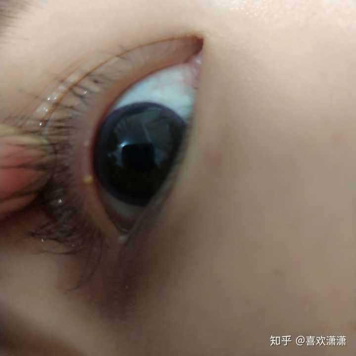 眼皮内的上眼睑,长了一个白色颗粒儿,点了一个月的日本眼药水也没有用