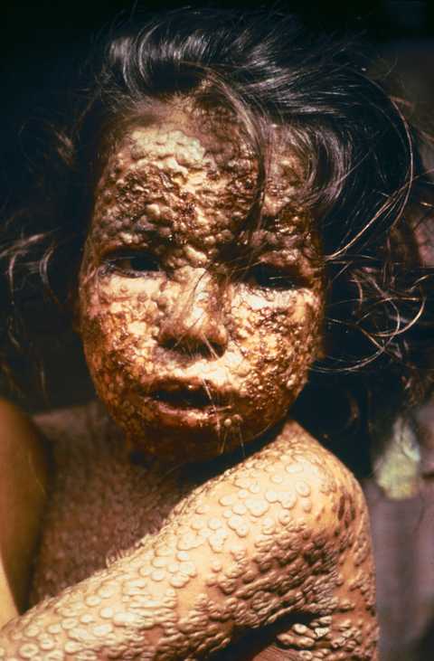 天花 (small pox)是一种由天花病毒引起之人类传染病.