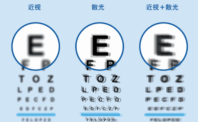 什么是「散光」,产生的原因是什么,如何预防?