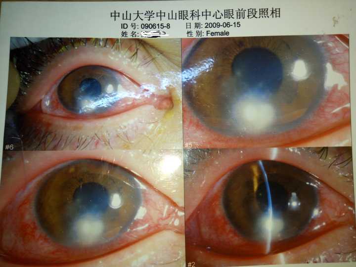 如下图,角膜翳已经扩散到瞳孔区,形成对视力的影响,以下照片是真菌性