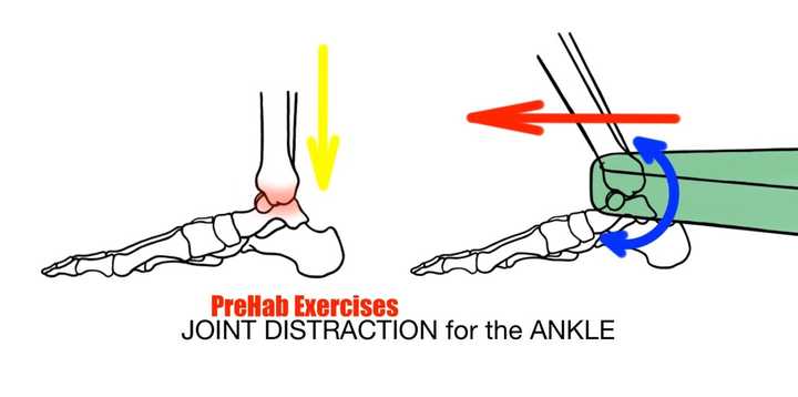 关节活动度的恢复: 尽量恢复背屈的关节活动度,可以采取小腿三头肌的