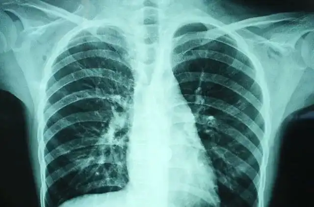 再加上胸片清晰度很有限,早期肺癌,就一粒芝麻大小.