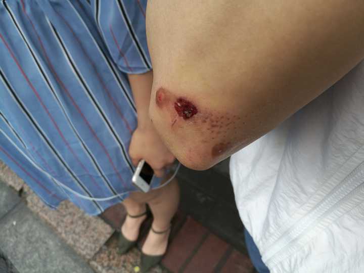 不过还好都是磕肿或者皮外伤 最近比较严重的一次擦伤胳膊肘