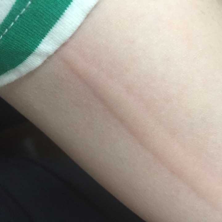 人工荨麻疹(皮肤划痕症)的原理是什么?有治疗的必要么