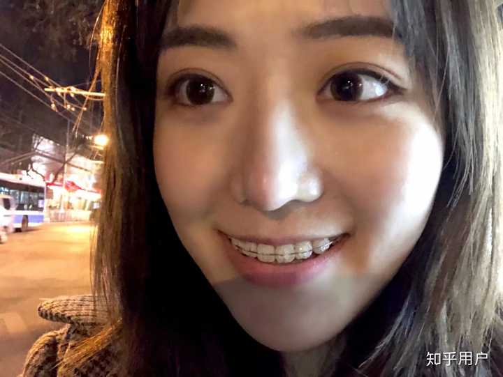 戴牙套(正畸)是什么体验?