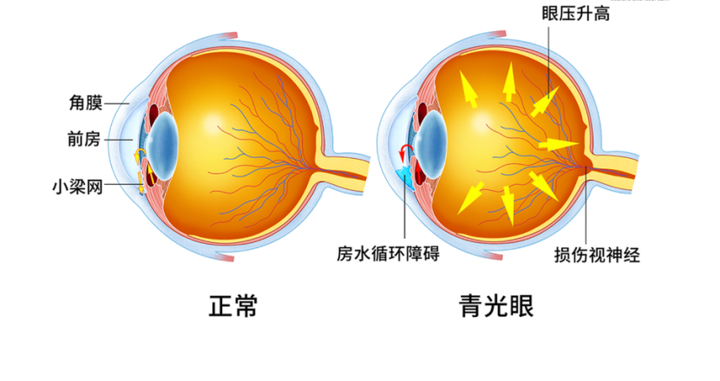 青光眼是 一组以视乳头萎缩及凹陷,视野缺损及视力下降为共同特征的