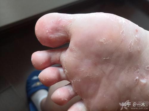 脚气有哪些症状?