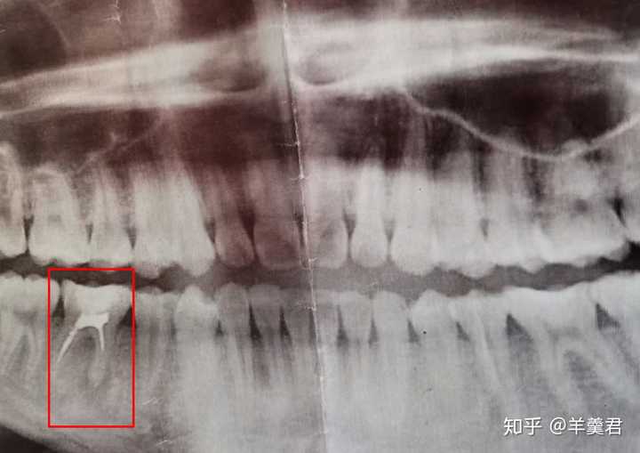 根管治疗疼不疼?