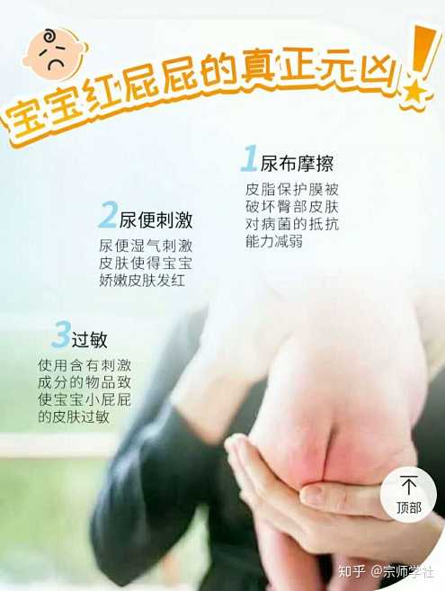 来看下宝宝红屁屁的原因