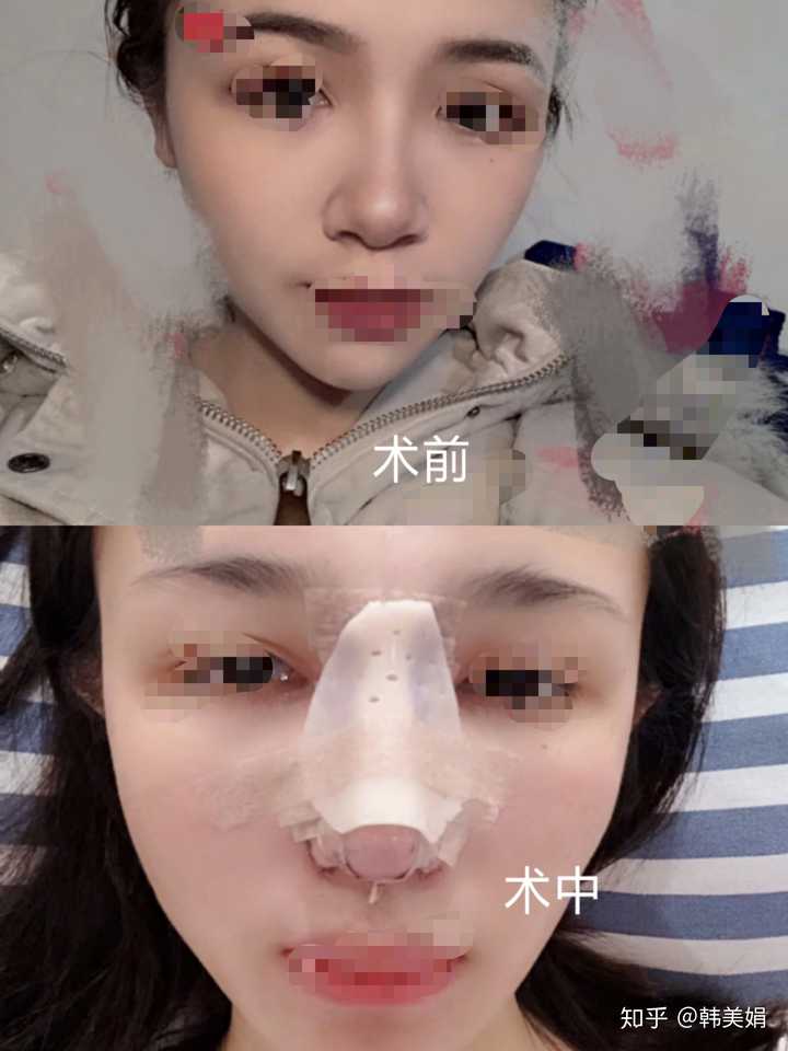 隆鼻失败的概率高吗?