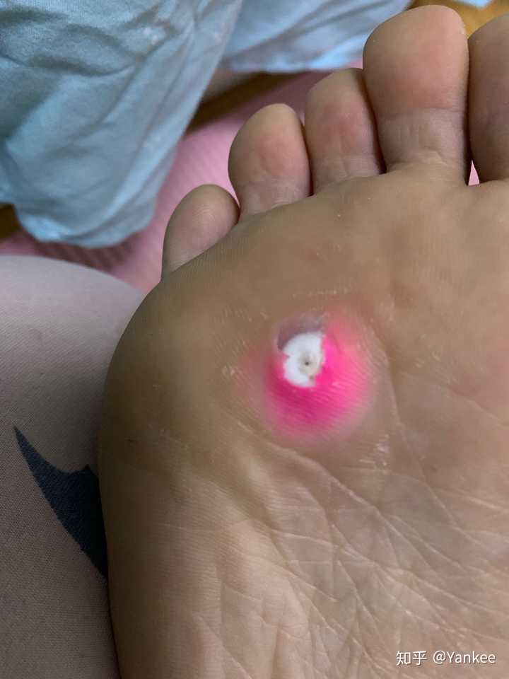 鸡眼怎么彻底挖出?