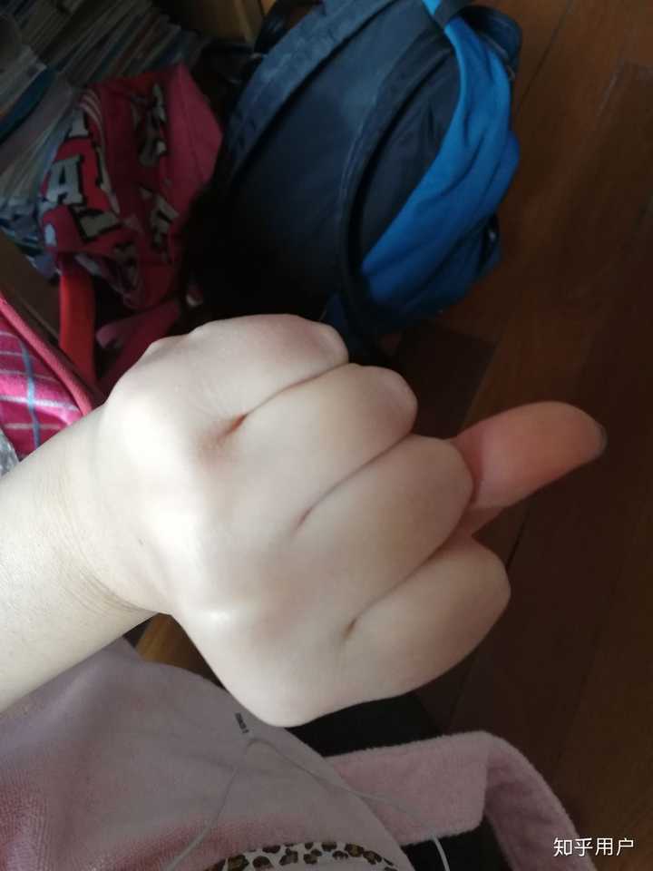 如图,丑的要死的手,又黑又胖手指肿胀
