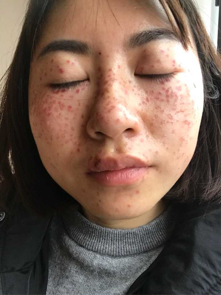 激光祛斑是治标不治本吗?