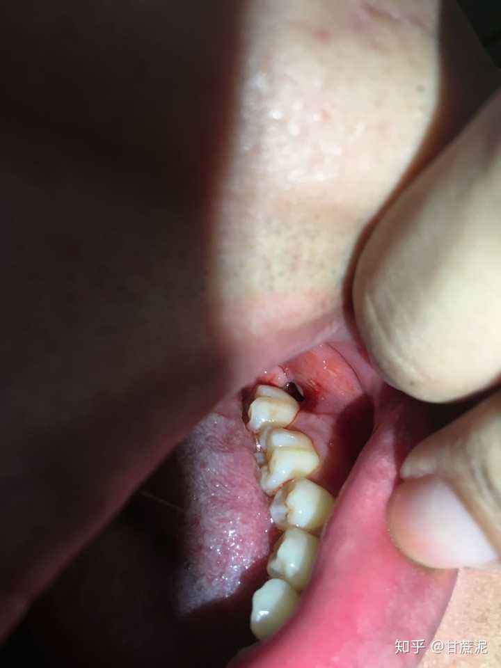拔完智齿第十天,脸和牙之间有个洞正常吗?