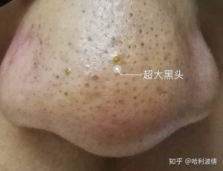 史上最大的黑头有多大?