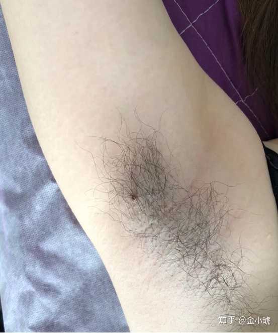 我之前在网上看的用镊子拔可以永久去腋毛,难道是拔出狐臭了?