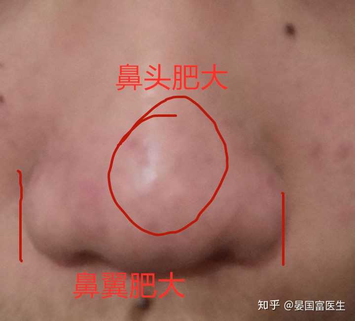鼻头鼻翼肥大怎么改善