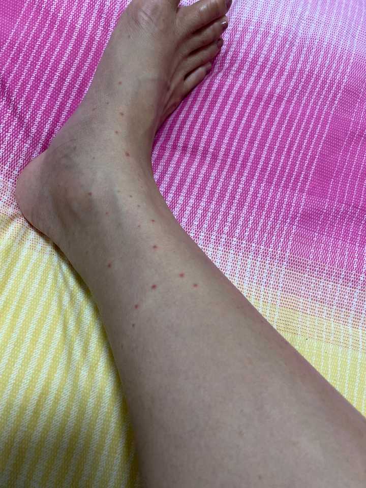 为什么我被蚊子咬了不起包,只有一个小红点,是什么原因?