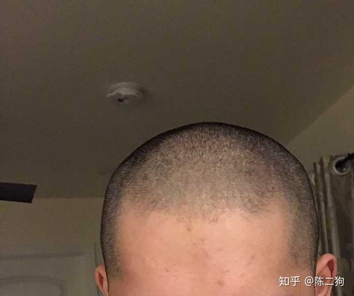 留光头有哪些需要注意的地方?