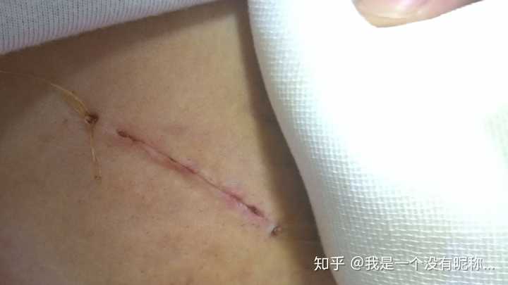 乳腺纤维瘤必须做手术吗?复发率很高吗?