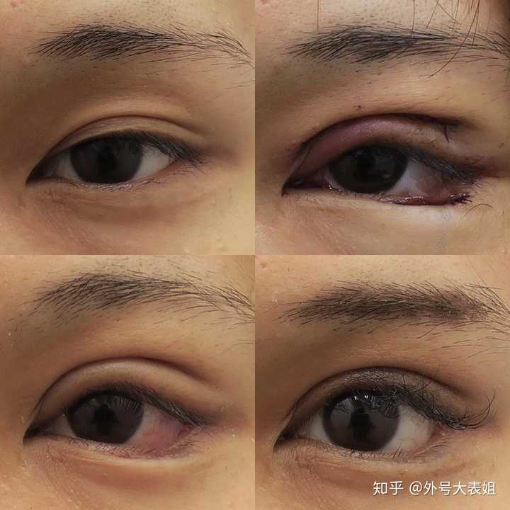 为什么割的双眼皮会显得假?