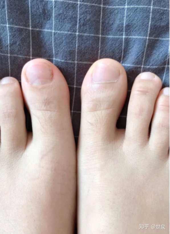 大脚趾甲很厚是灰指甲?