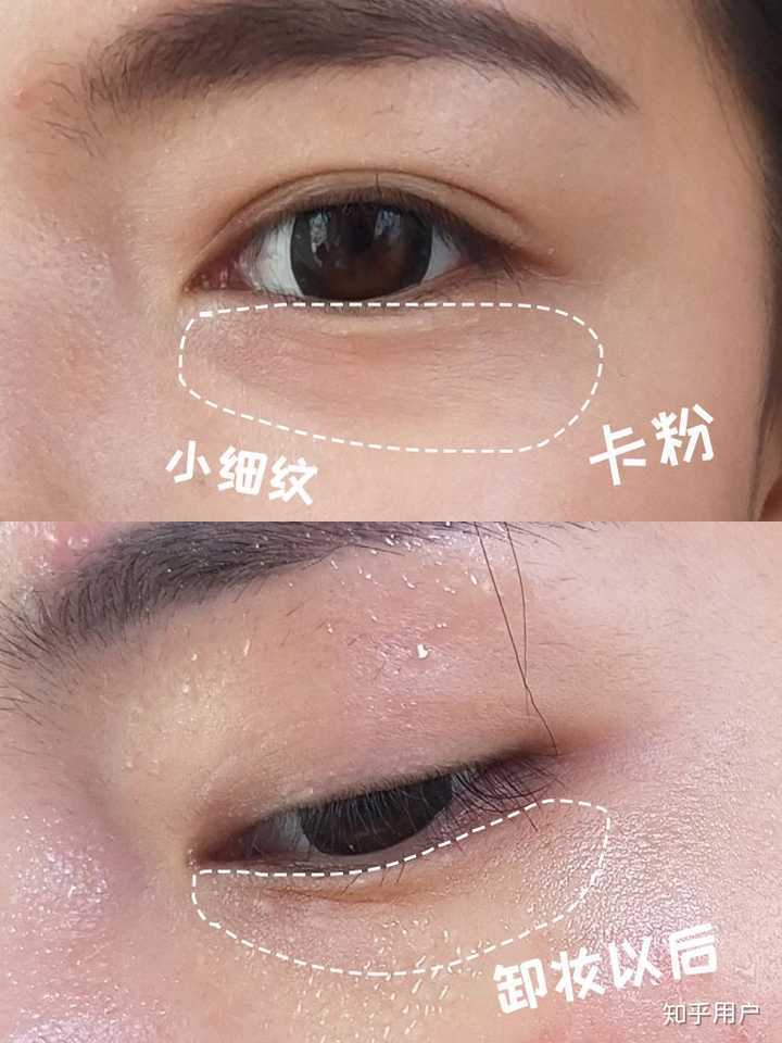 20岁出头眼部细纹多干燥且黑眼圈严重用什么眼霜合适?