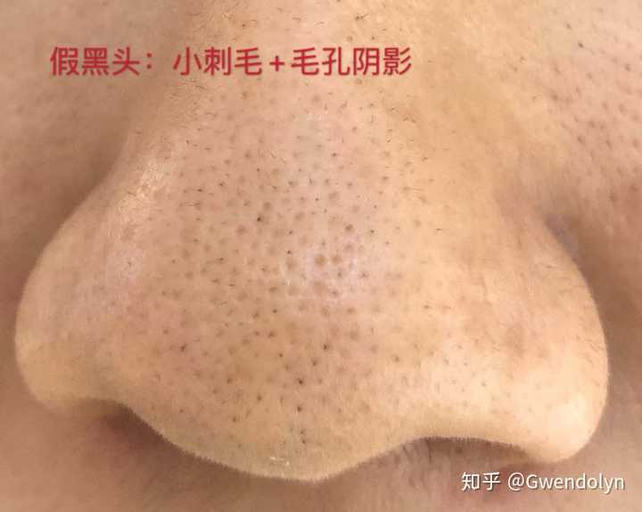 如何快速有效地去黑头?
