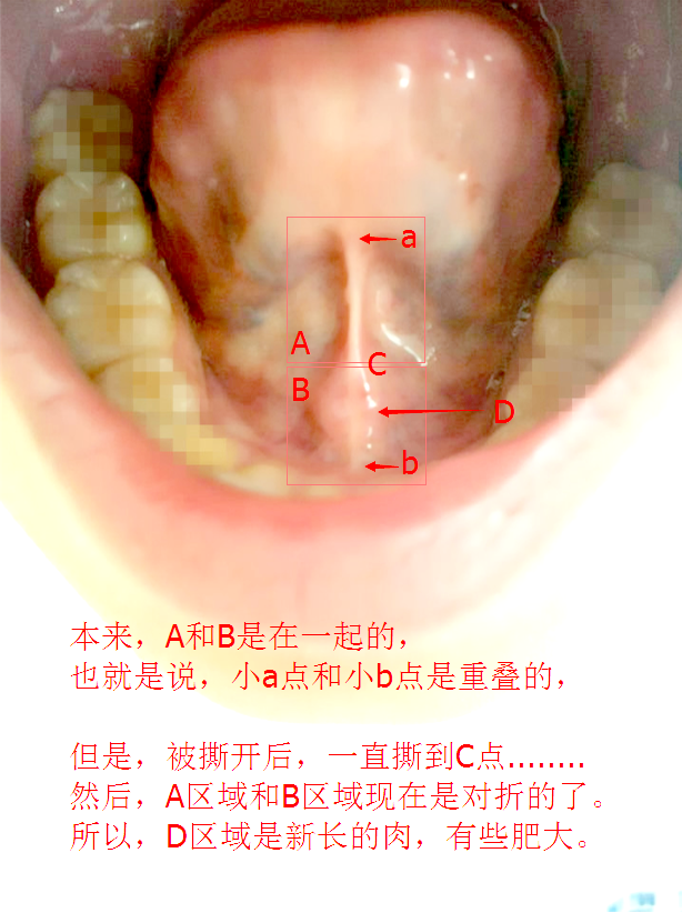 和女朋友接吻舌头系带被吸断了,怎么办 需要再缝上么?