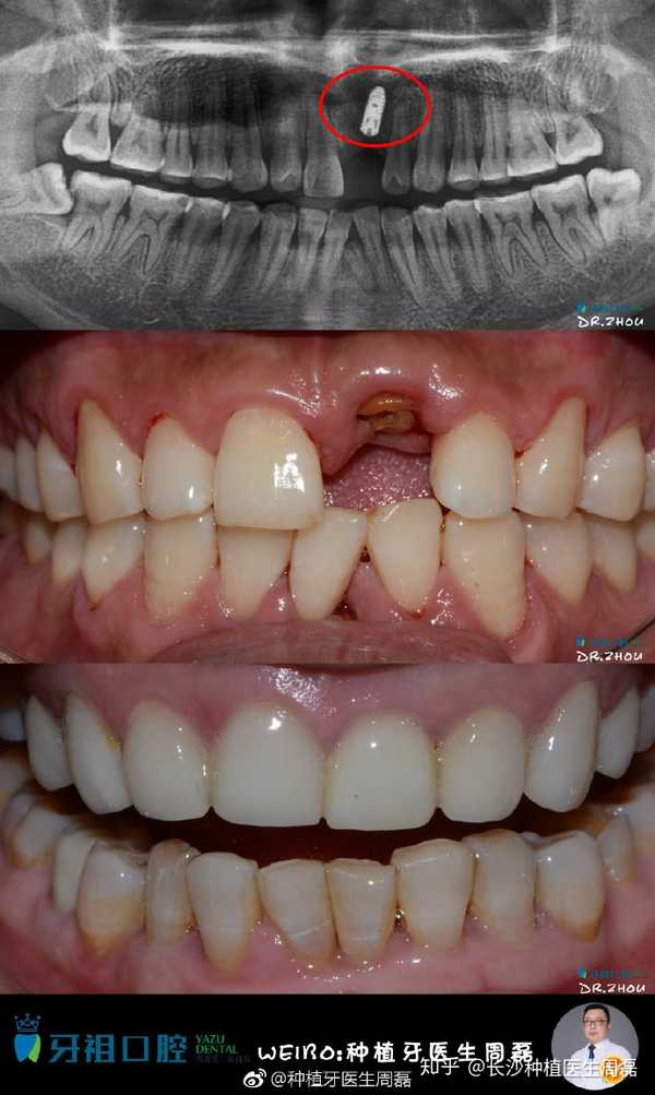 年前单颗种植案例分享,患者因外伤至门牙缺失,长期不去处理,直到牙龈