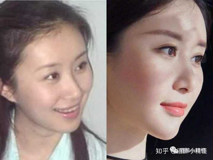 自体脂肪填充额头怎么会填成寿星公?