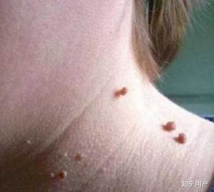 扁平疣有治愈的方法么?