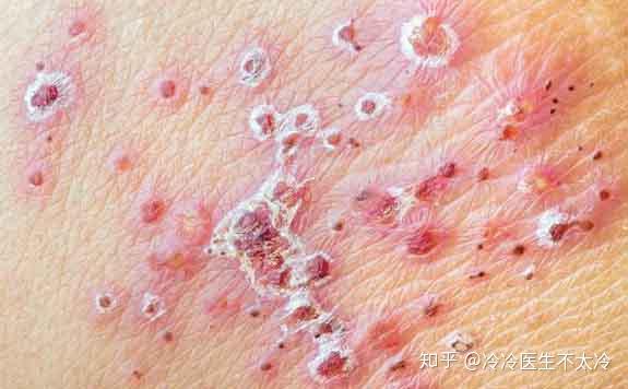 生殖器疱疹是种怎样的疾病?