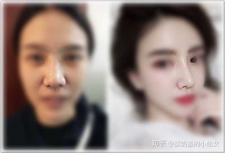 广州哪家整形医院的医生做隆鼻的好的?