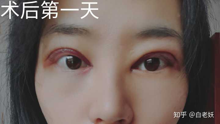 做双眼皮手术是怎样的一种体验?