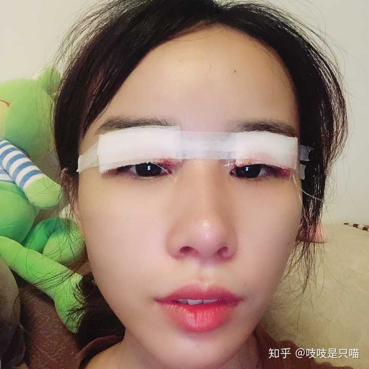 割双眼皮是种怎样的体验?