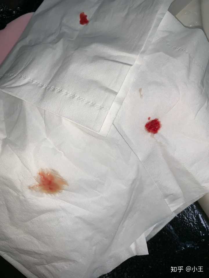 长火疖子怎么治?很恐怖吗?