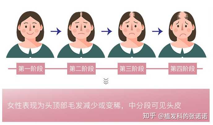 女生脱发判断等级示意图